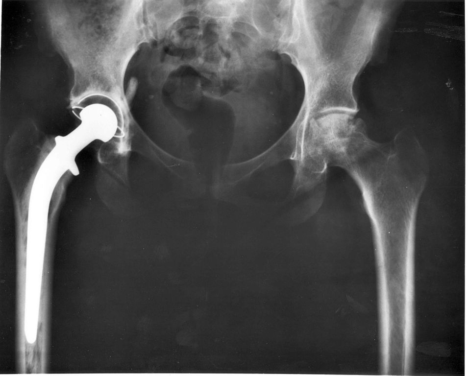 Mercy Memorial Hospital System Announces Direct Anterior Approach to Hip Replacement